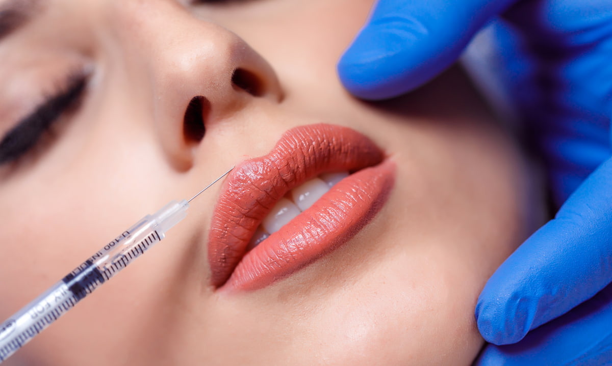 Juvederm Injected into Lips