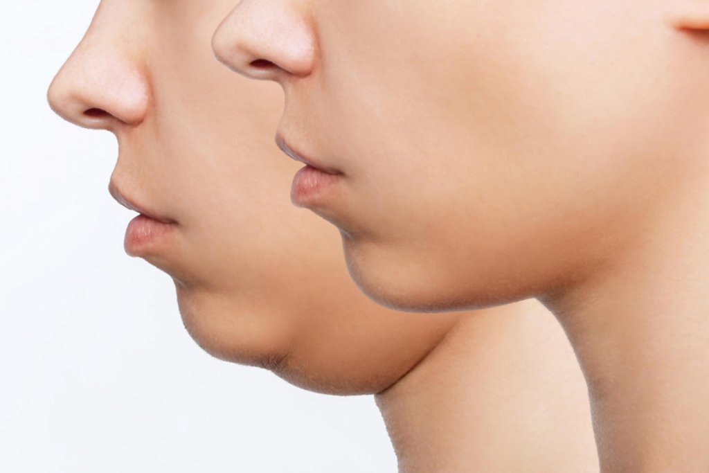 double chin before and after