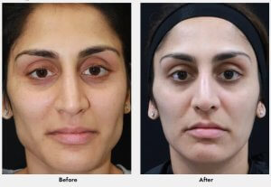 Botox Treatment Before and After 2