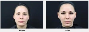 Botox Treatment Before and After 1