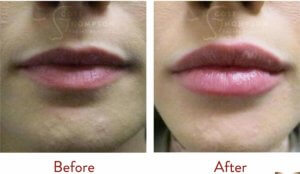 juvederm voluma for lips before and after