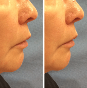 radiesse before and after jowls 1