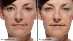 radiesse before and after jowls 2