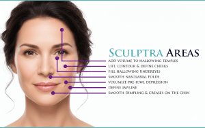 sculptra injection points face